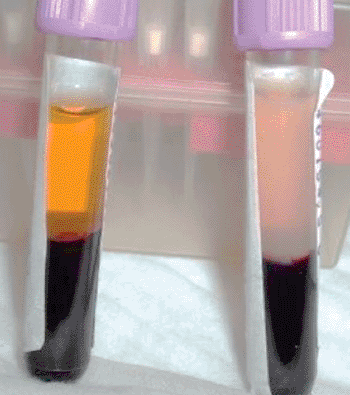 Image: Normal blood sample on the left and blood sample containing high triglycerides on the right (Photo courtesy of Prof. Tisha Joy, MD).